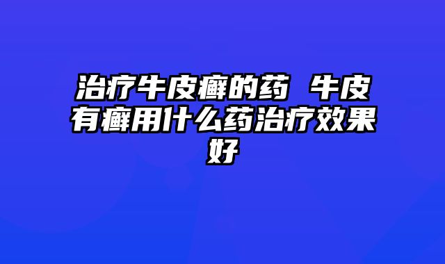 治疗牛皮癣的药 牛皮有癣用什么药治疗效果好
