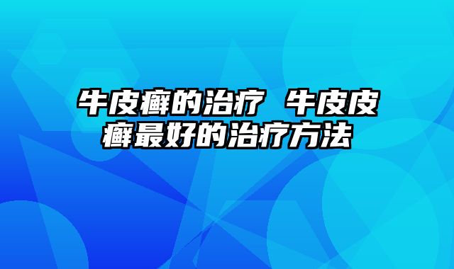 牛皮癣的治疗 牛皮皮癣最好的治疗方法