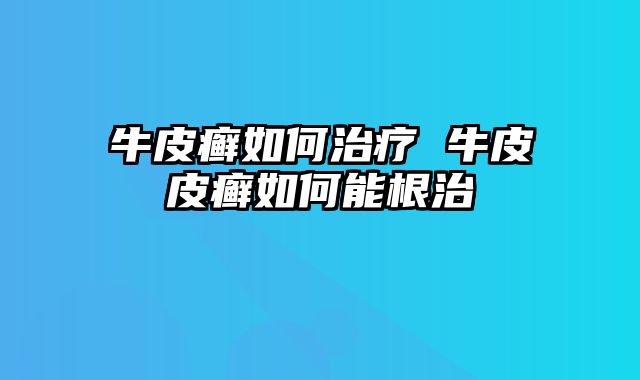 牛皮癣如何治疗 牛皮皮癣如何能根治