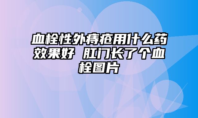血栓性外痔疮用什么药效果好 肛门长了个血栓图片