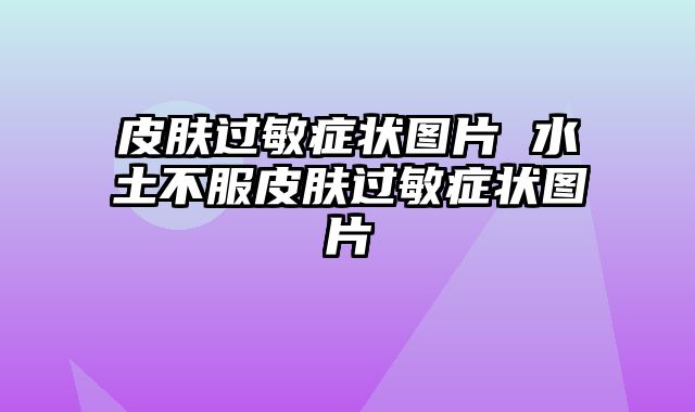 皮肤过敏症状图片 水土不服皮肤过敏症状图片