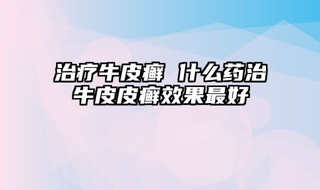 治疗牛皮癣 什么药治牛皮皮癣效果最好